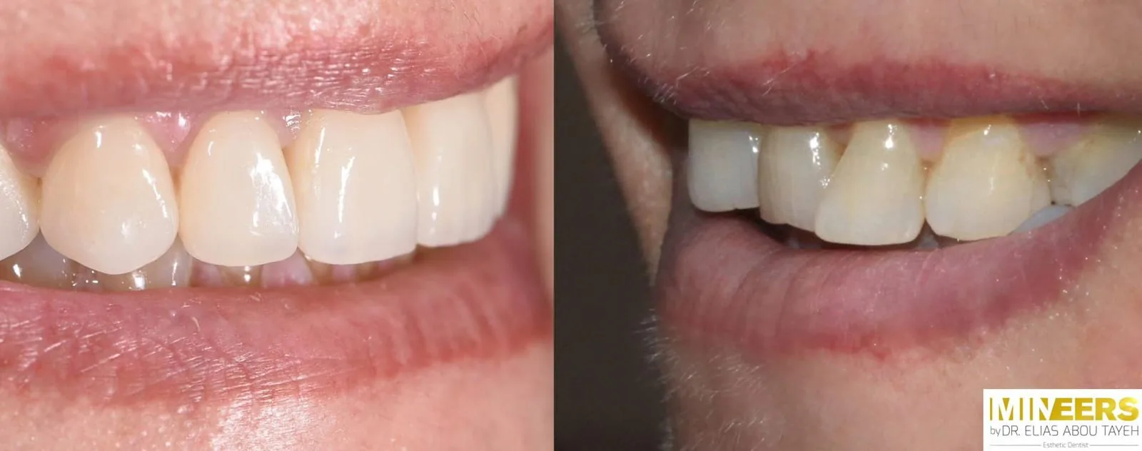 Veneer showcase