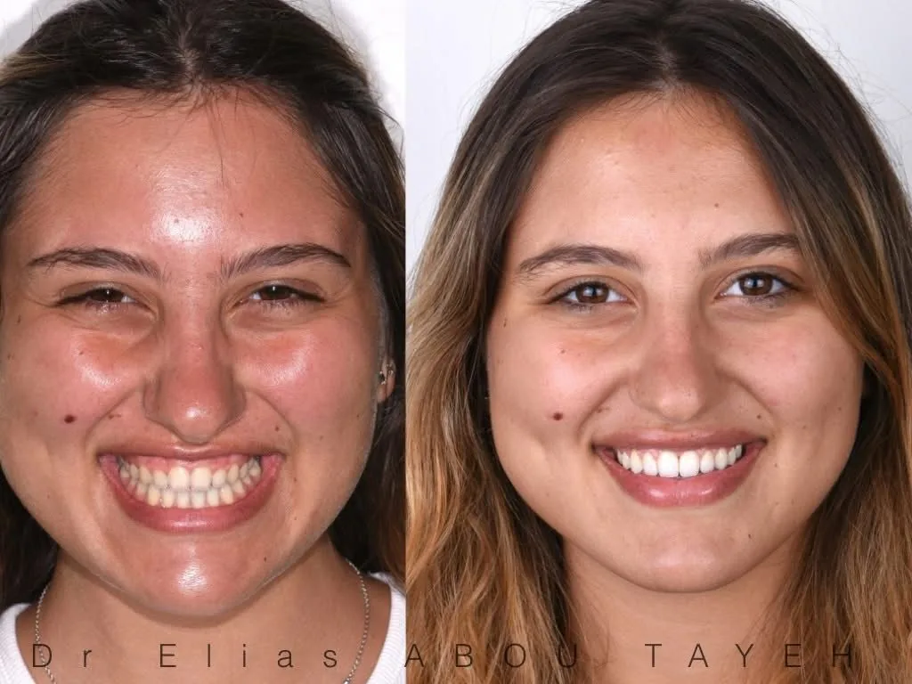 Veneer showcase