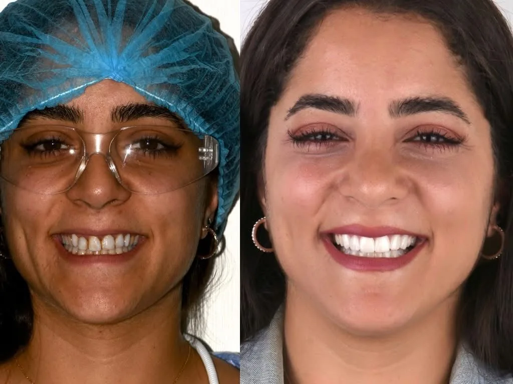 Veneer showcase