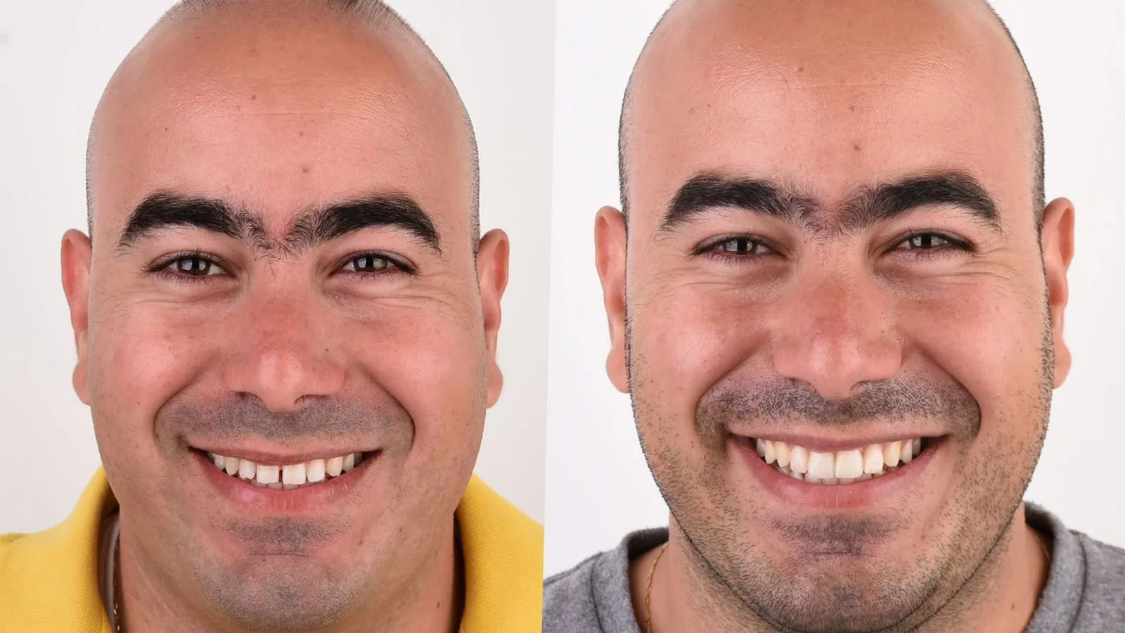 Veneer showcase