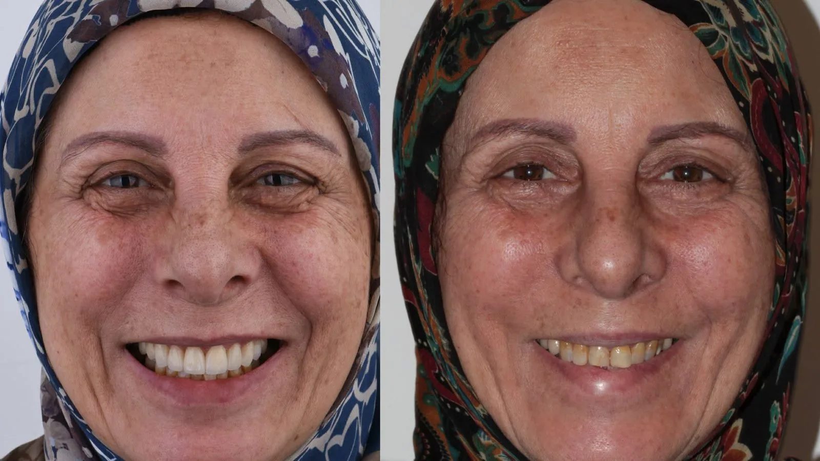 Veneer showcase