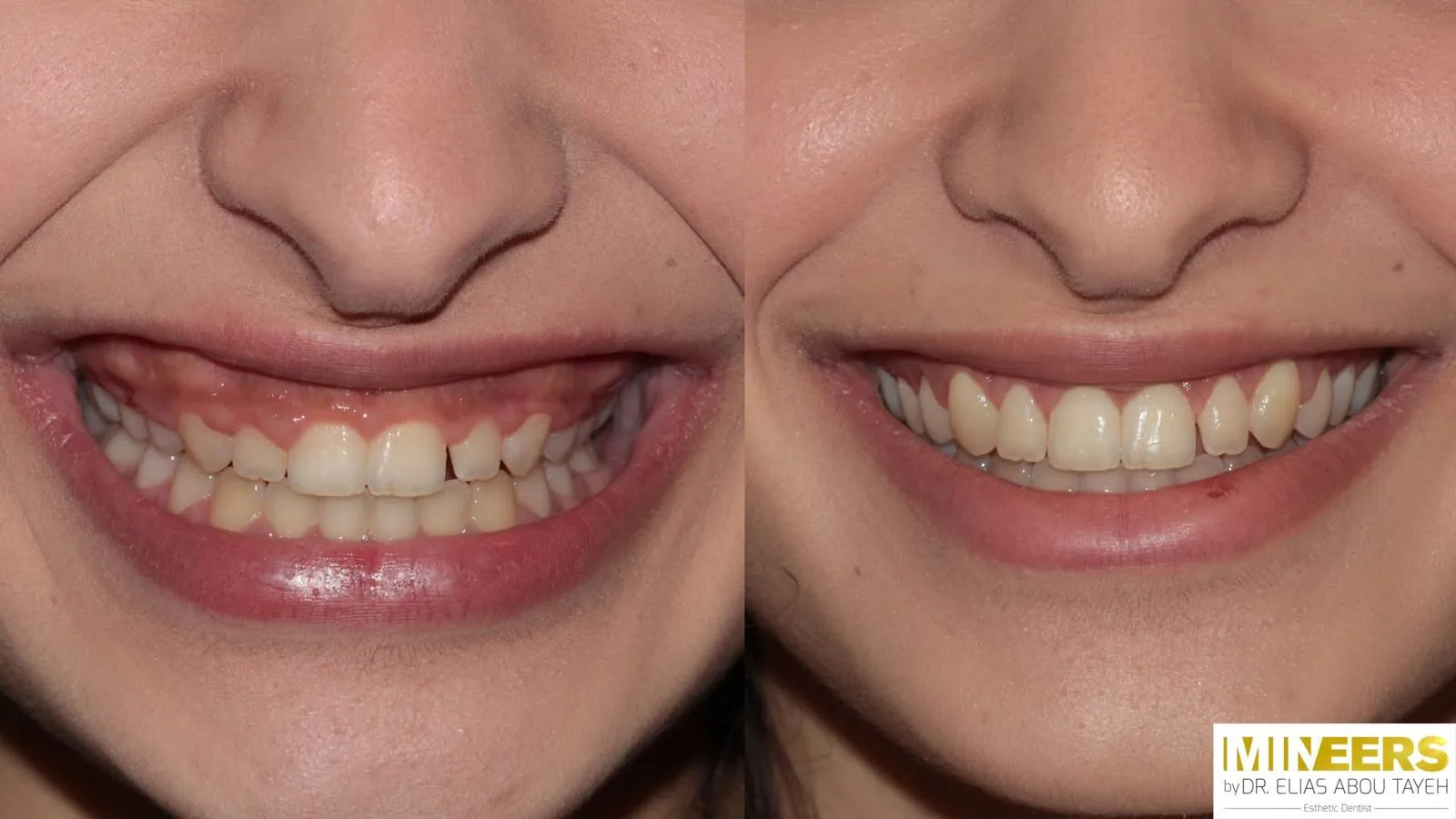 Veneer showcase