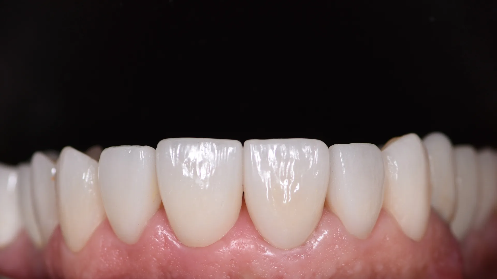 Veneer showcase