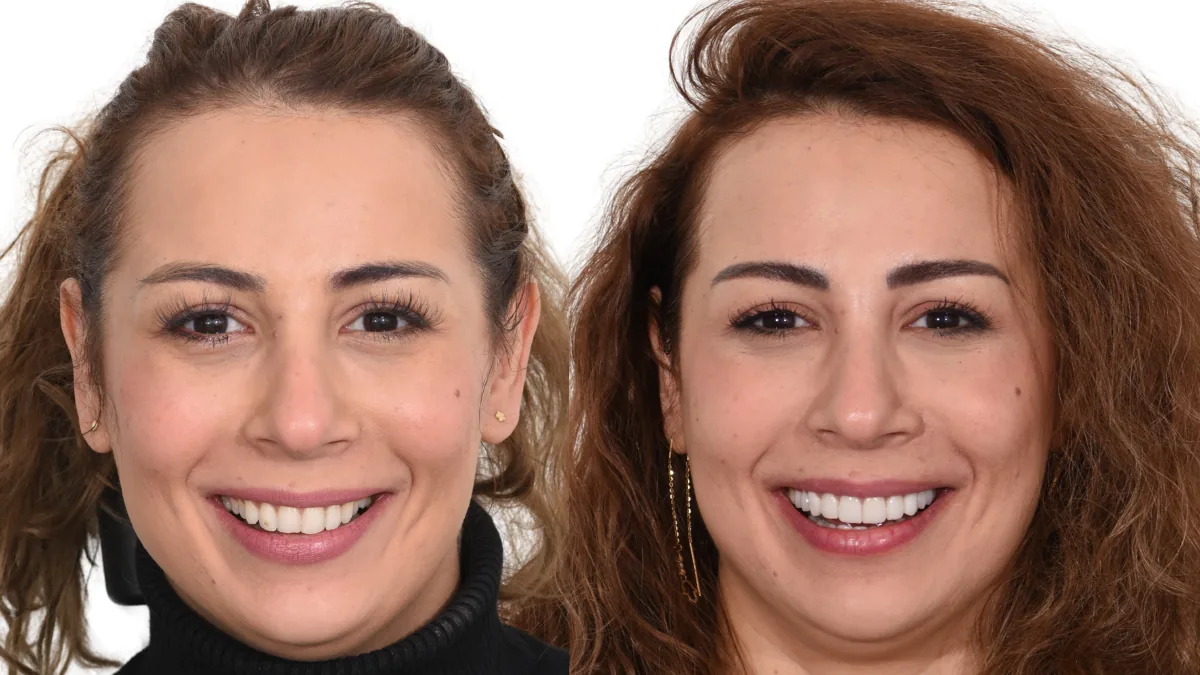 Complete Smile Makeover