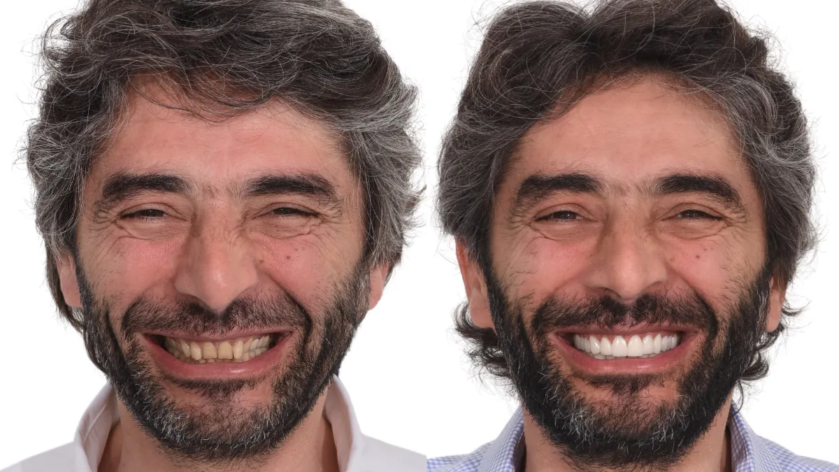 Tooth Reshaping