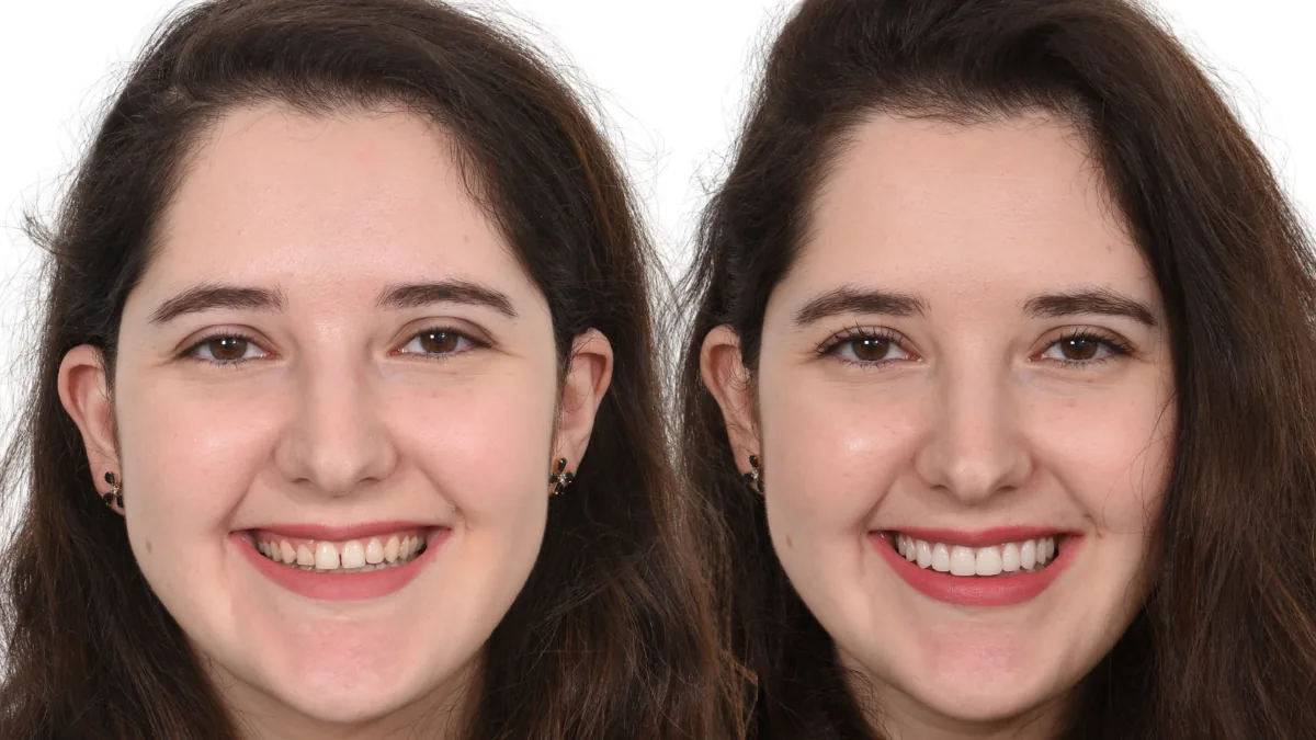 Gap Closure